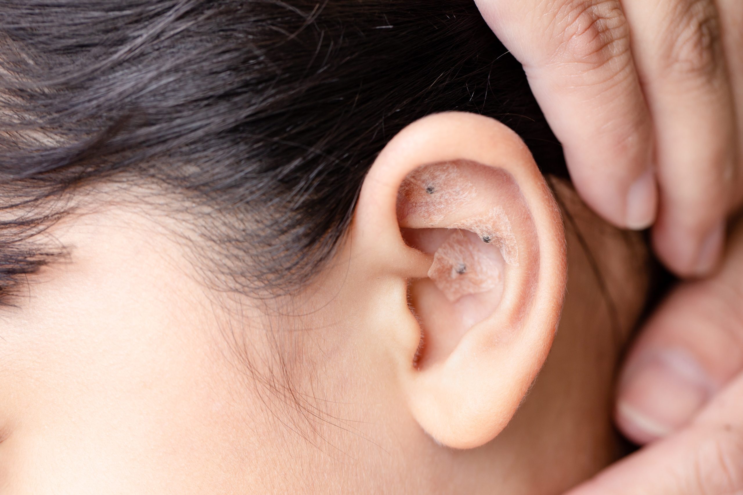 Ear seeds on woman