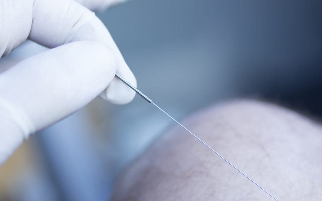 What you must know before you try dry needling