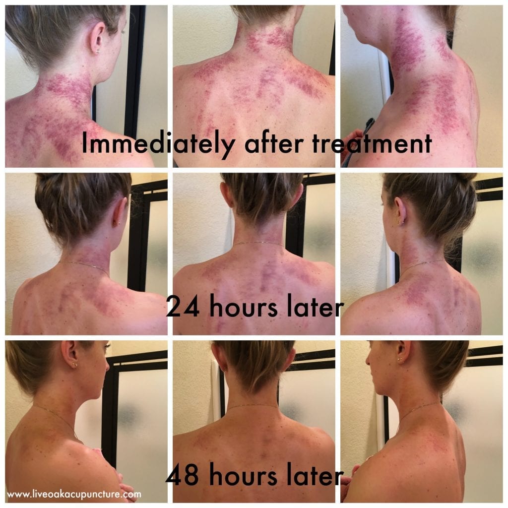 Collection of images after Gua Sha at 24 and 48 hour marks