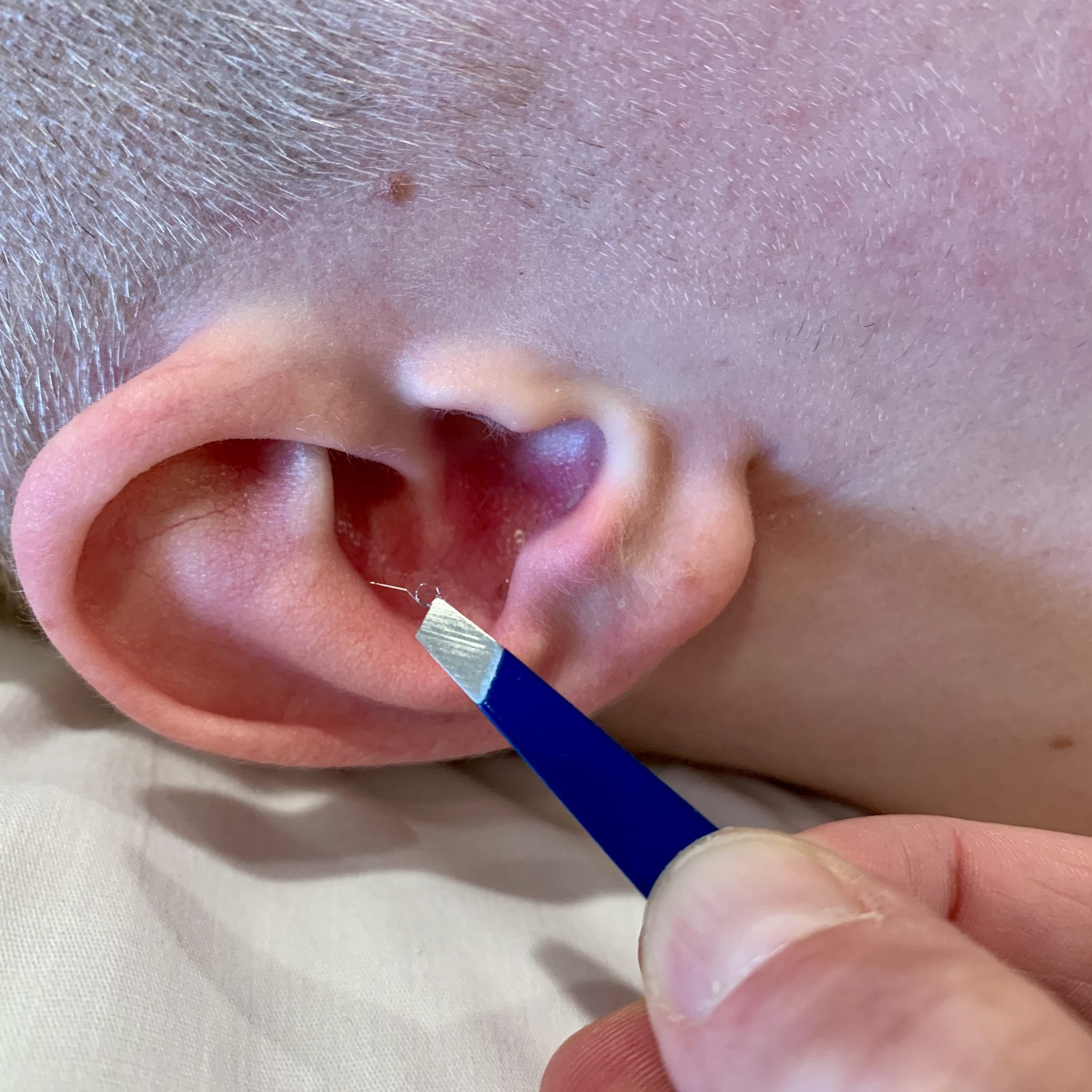 Spinex Needle near ear