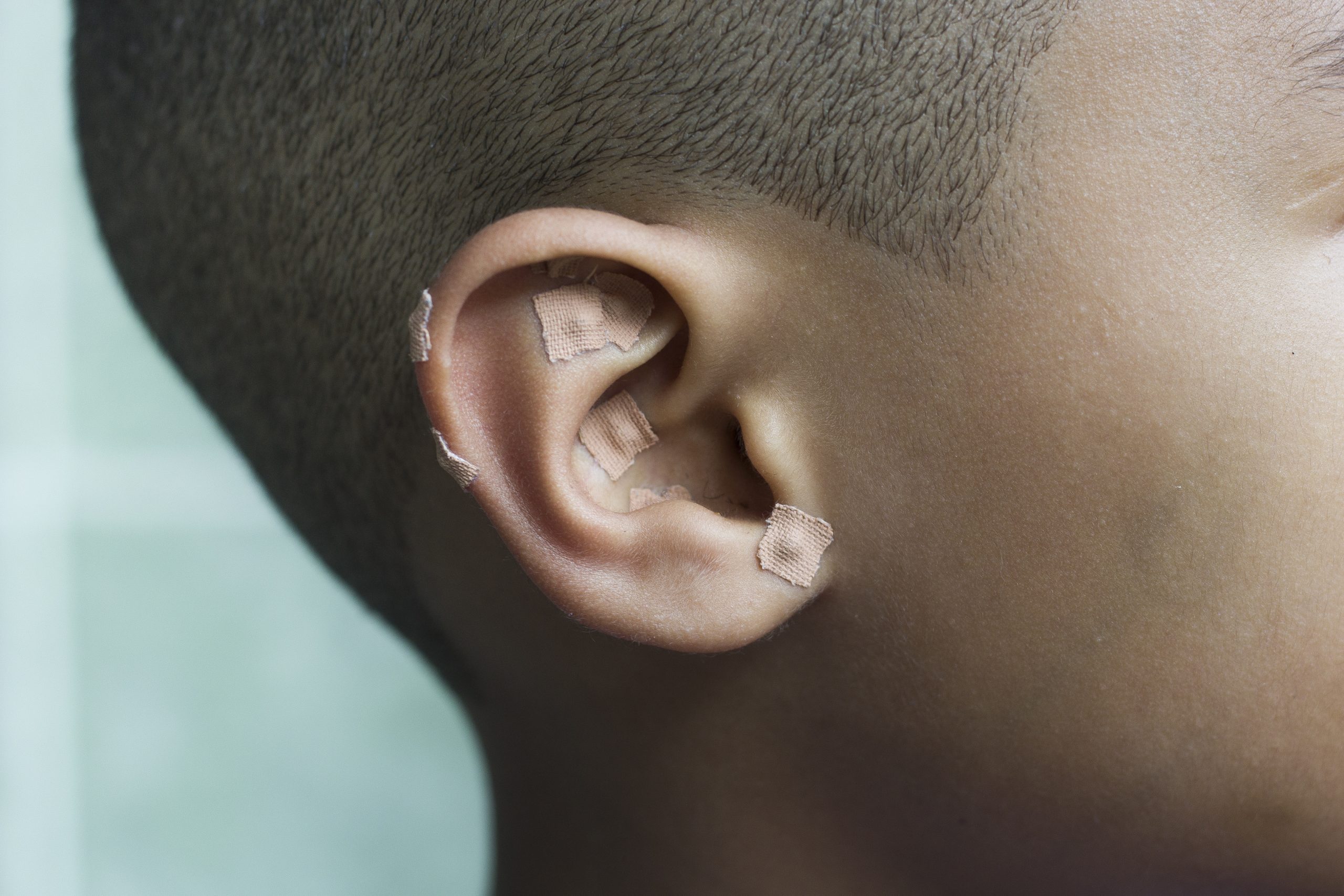 Что такое оталгия уха. Евстахиит барабанная перепонка. Что такое оталгия уха. Что такое оталгия уха. Что такое оталгия уха.